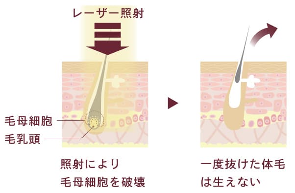 すずき内科の医療レーザーの仕組み断面図。照射により毛母細胞を破壊。一度抜けた体毛は生えない。