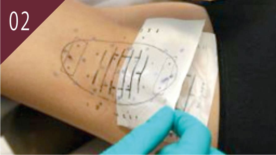 ミラドライ照射準備 マーキングにより範囲を確認している様子