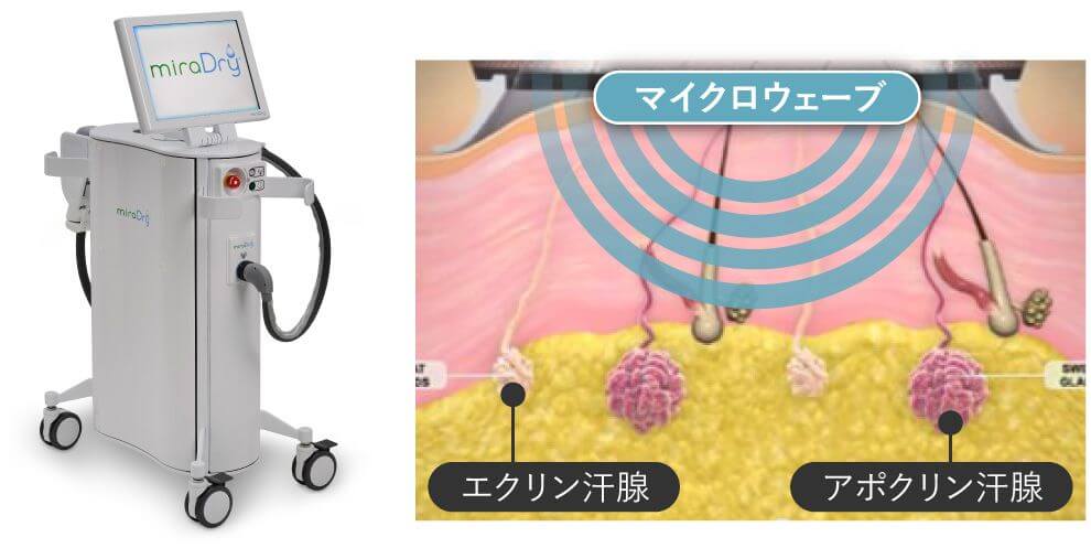 ミラドライの治療器とメカニズムを説明する断面図