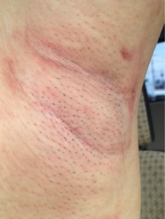 施術後の翌日の様子