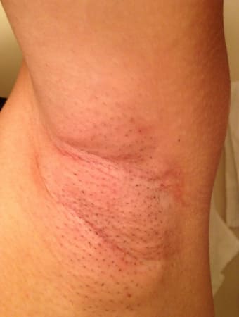 施術から3日後の様子