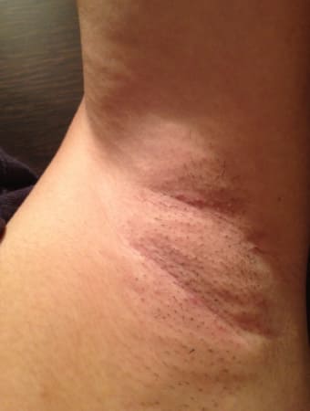 施術から7日後の様子