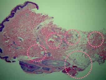 ミラドライ施術前のXXXで撮影した汗腺の様子