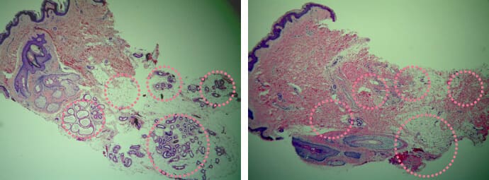 ミラドライ施術前後撮影した汗腺が破壊された様子